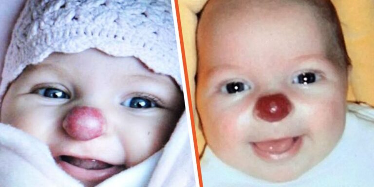 Girl Born with Red Nose Was Cruelly Called ‘Rudolph’ for It – Now at 15, She’s a ‘Gorgeous’ Teen