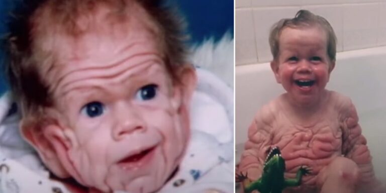 Tomm Tennent: The unique baby born with enough skin to cover the body of a five-year-old child