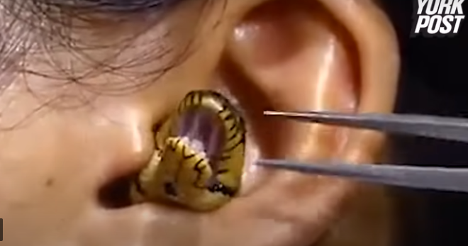 ‘Surgeon’ struggles to remove live snake from woman’s ear