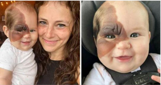 Mother wants to show 13-month-old daughter with rare birthmark how she is beautiful