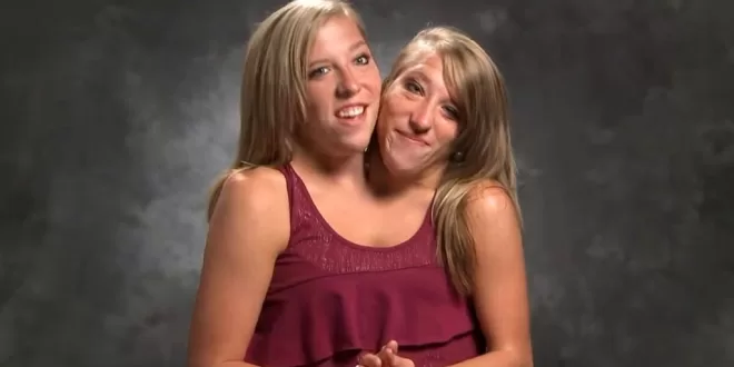 Conjoined Twin Sisters Abby and Brittany Hensel: Where are they Now?