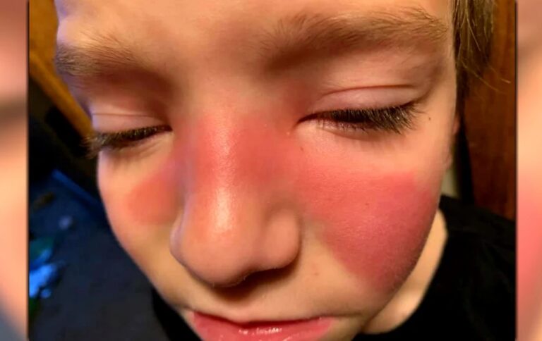 Her son came home with a red mark on his face, so she rushed him to the Emergency Room. This is scary stuff for parents everywhere.